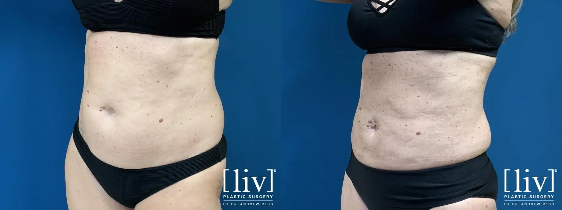 Liposuction: Patient 6 - Before and After 4