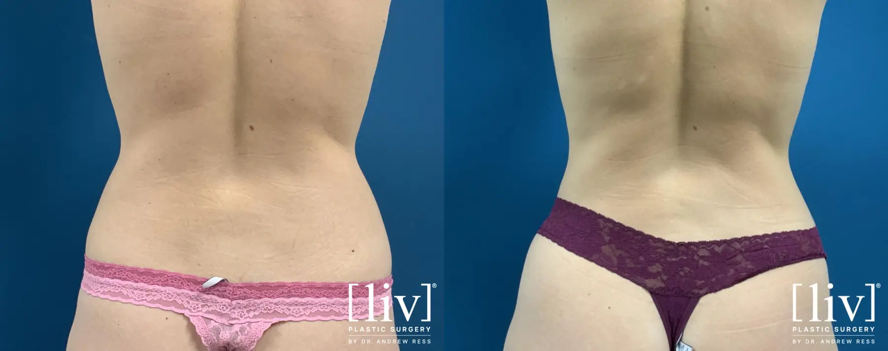 Liposuction: Patient 41 - Before and After 1
