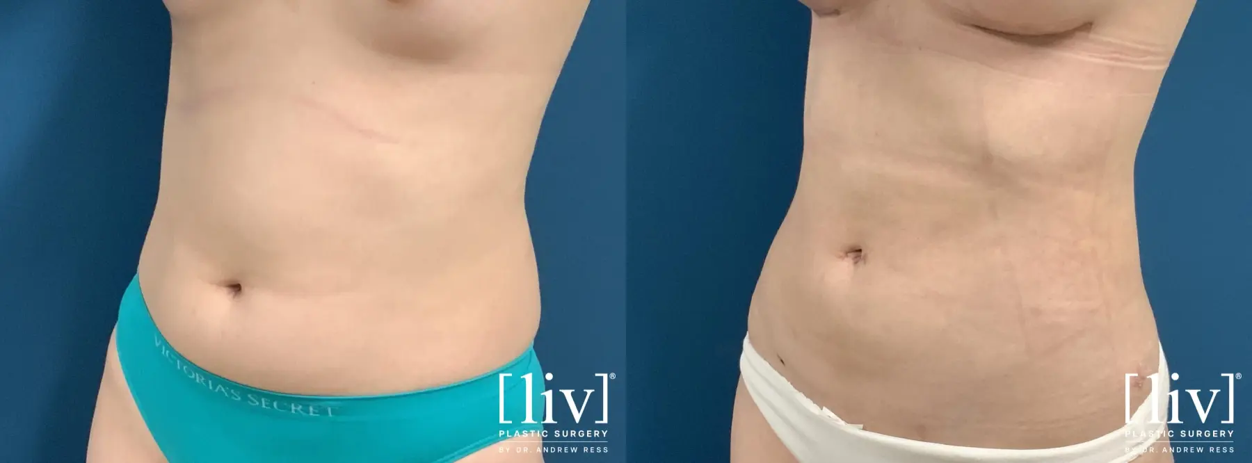 Liposuction: Patient 32 - Before and After 2
