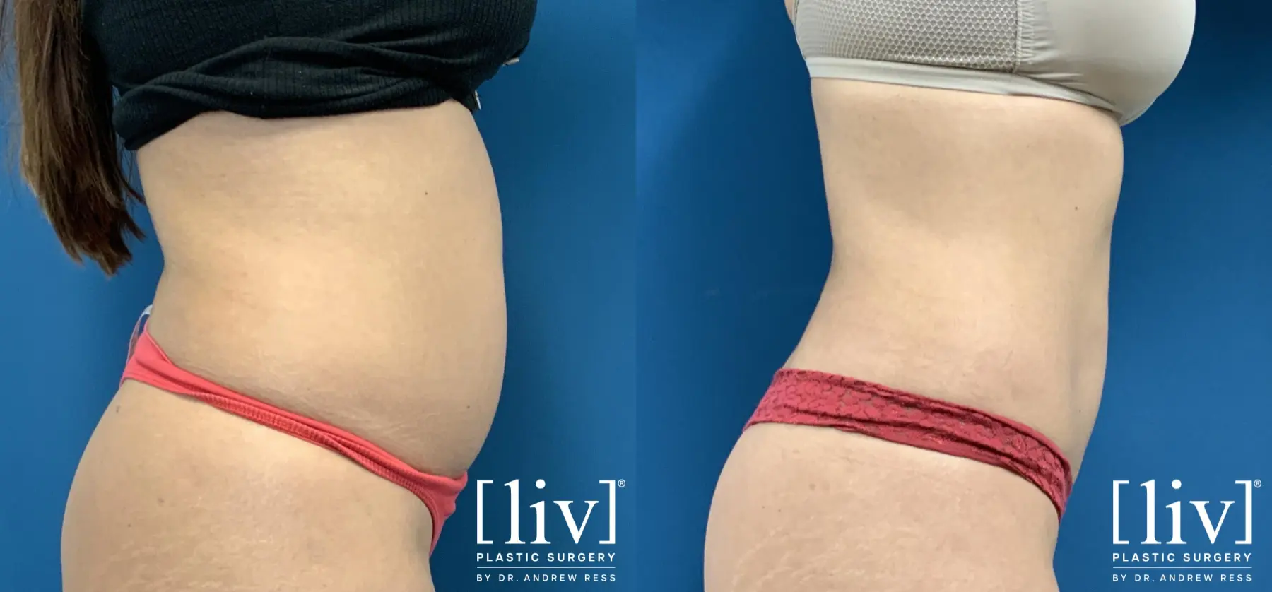 Liposuction: Patient 50 - Before and After 1