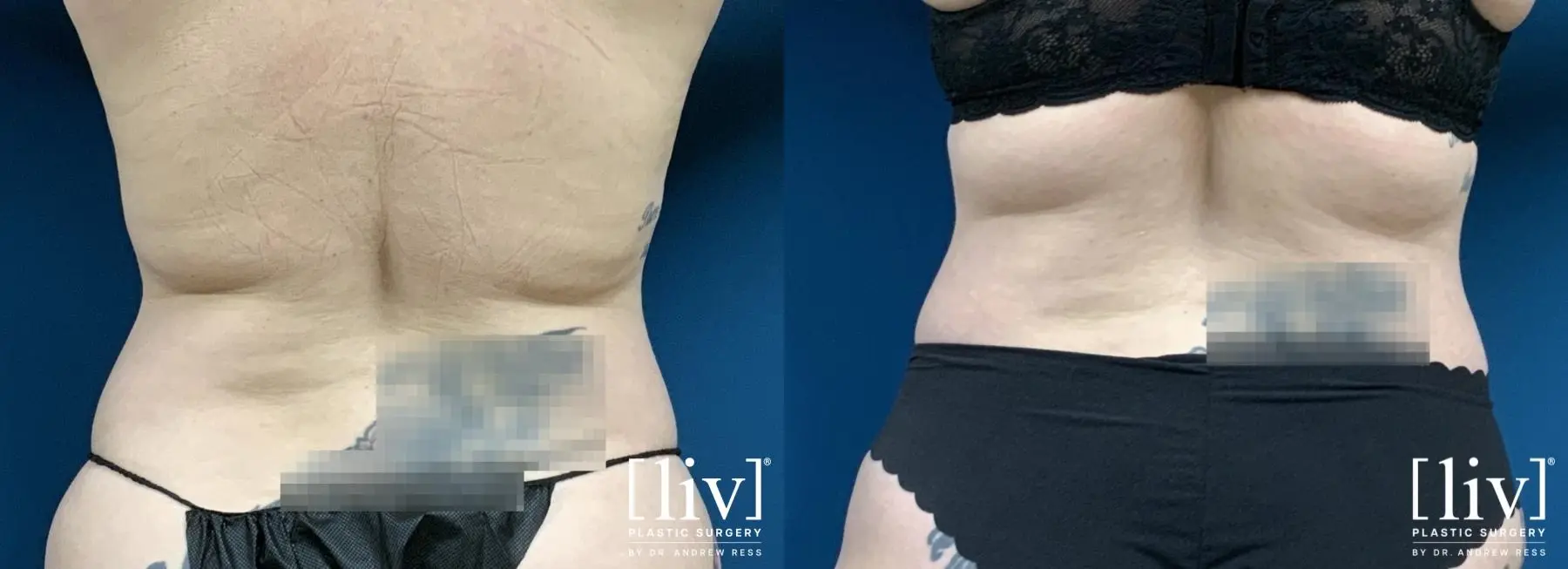 Liposuction: Patient 15 - Before and After 6