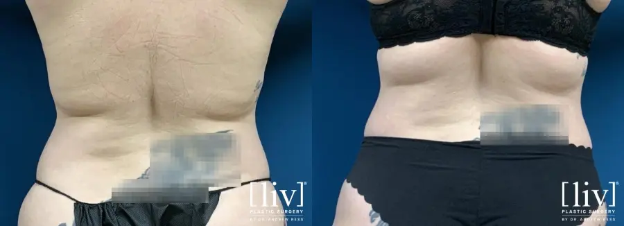 Liposuction: Patient 13 - Before and After 6