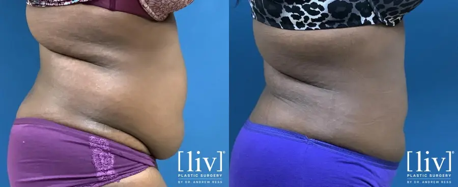Liposuction: Patient 7 - Before and After 3