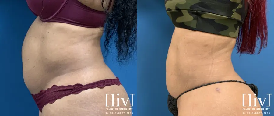 Liposuction: Patient 7 - Before and After 3