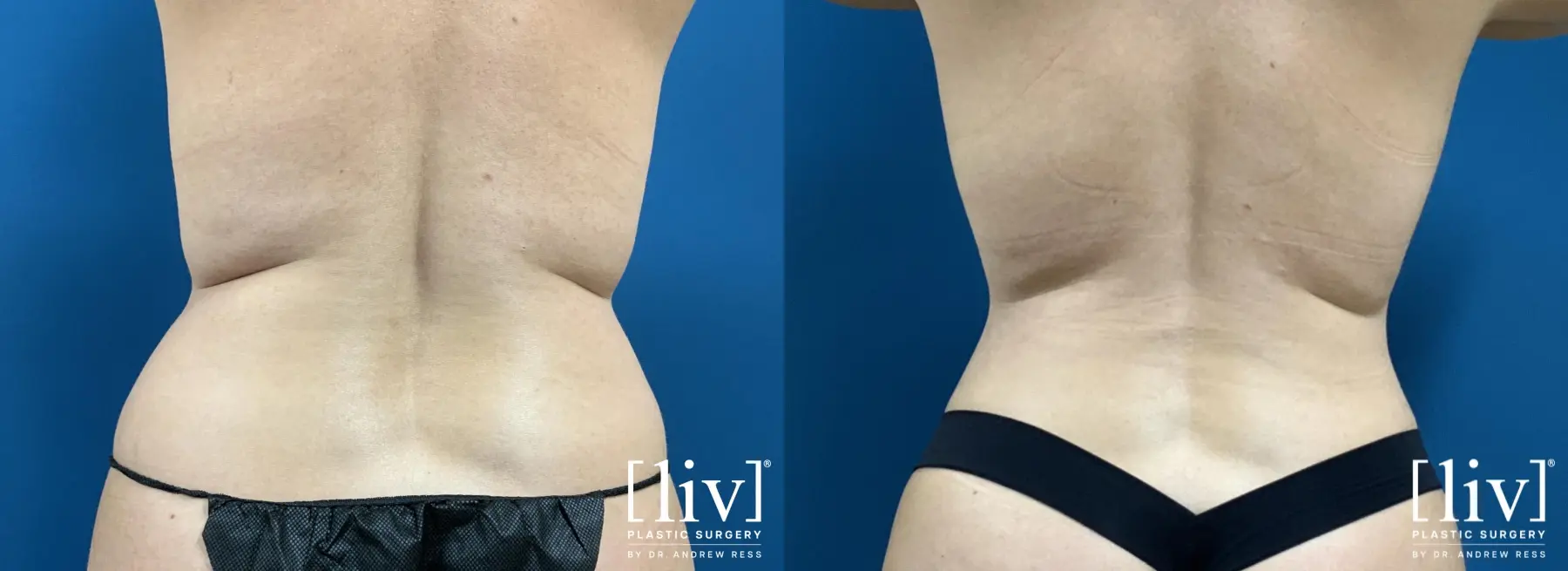 Liposuction: Patient 29 - Before and After 6