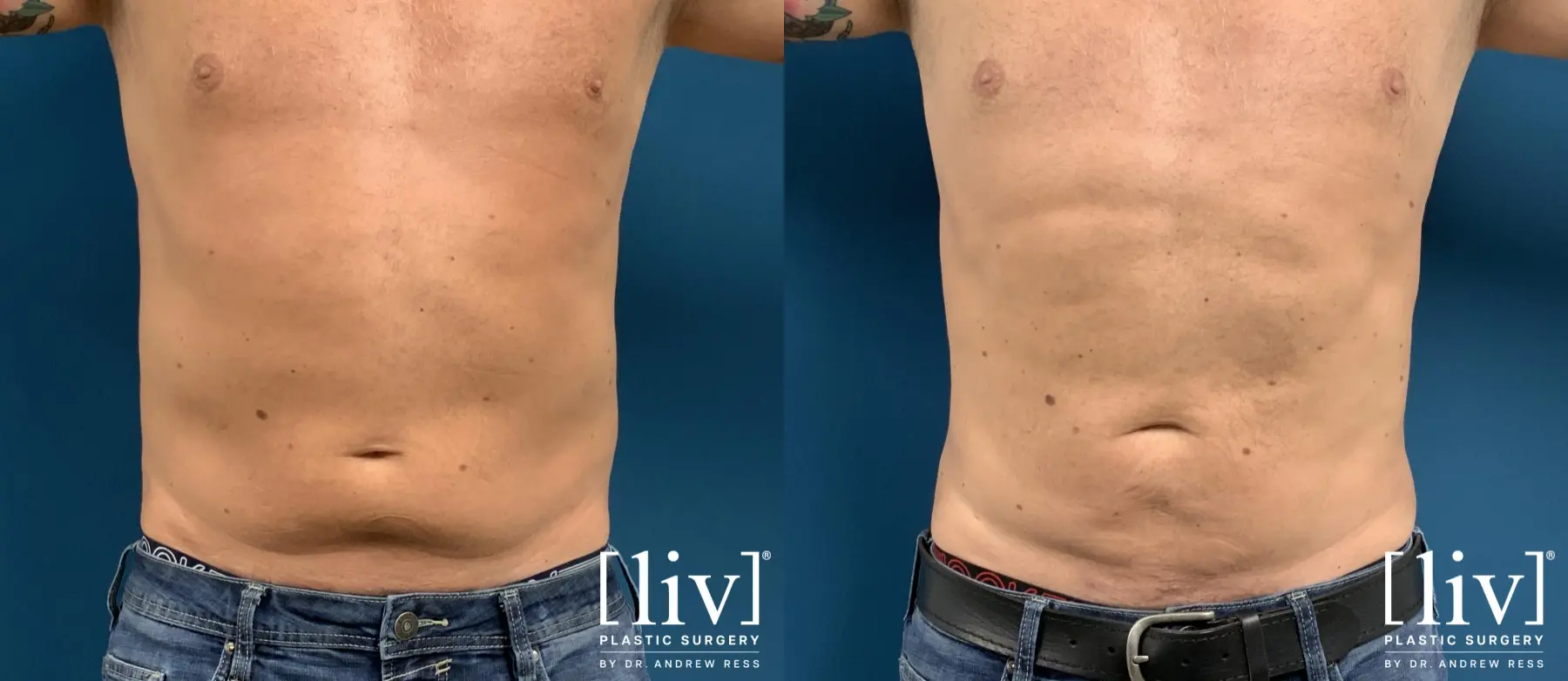 Men Liposuction - Before and After 1