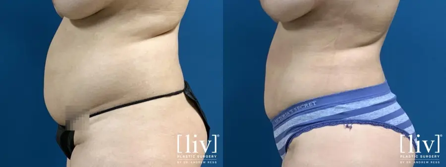 Liposuction: Patient 8 - Before and After 3