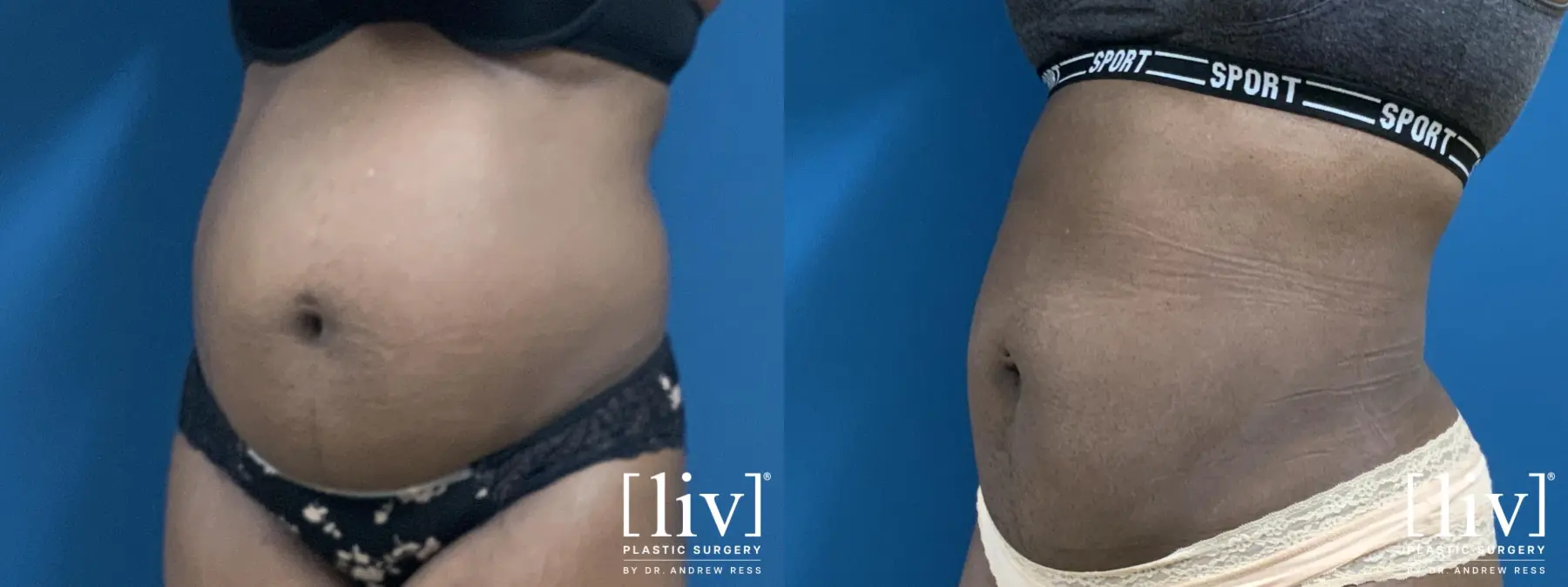 Liposuction - Before and After 2