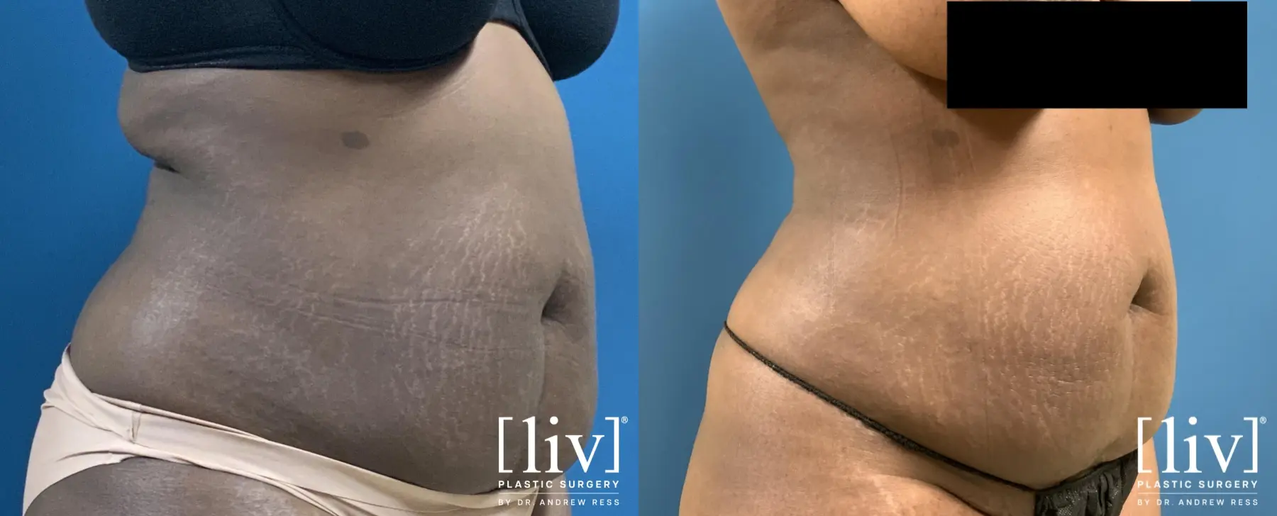 Liposuction: Patient 19 - Before and After 5