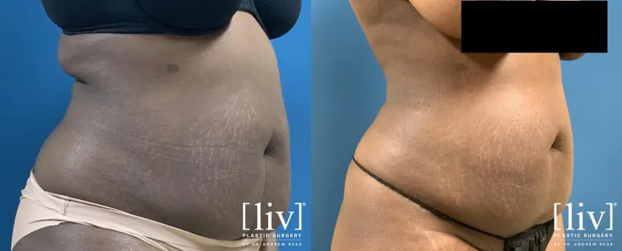 Liposuction: Patient 17 - Before and After 5