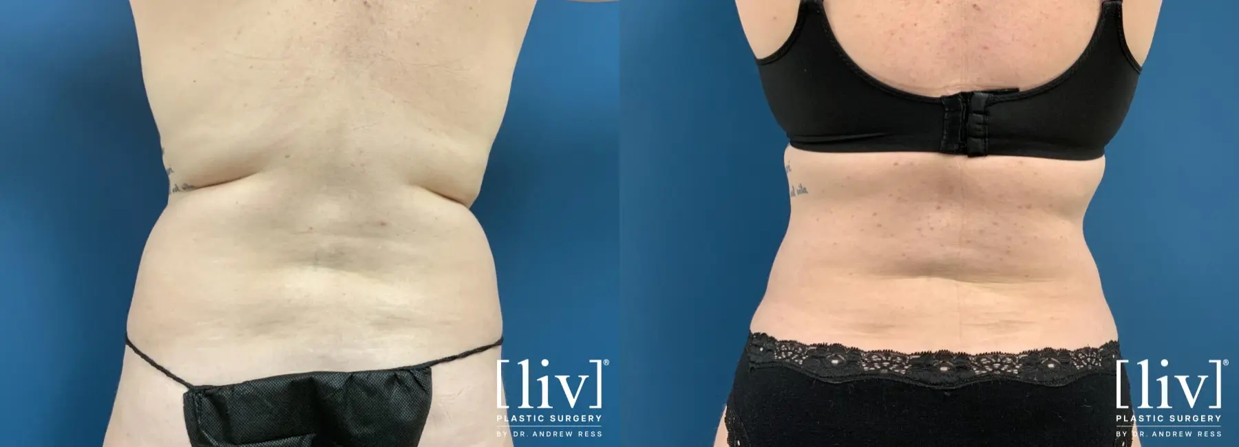Liposuction: Patient 30 - Before and After 4
