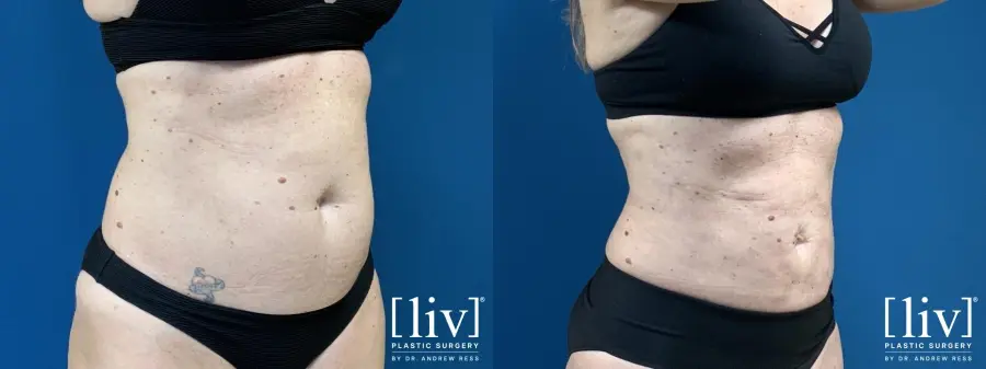 Liposuction: Patient 6 - Before and After 2