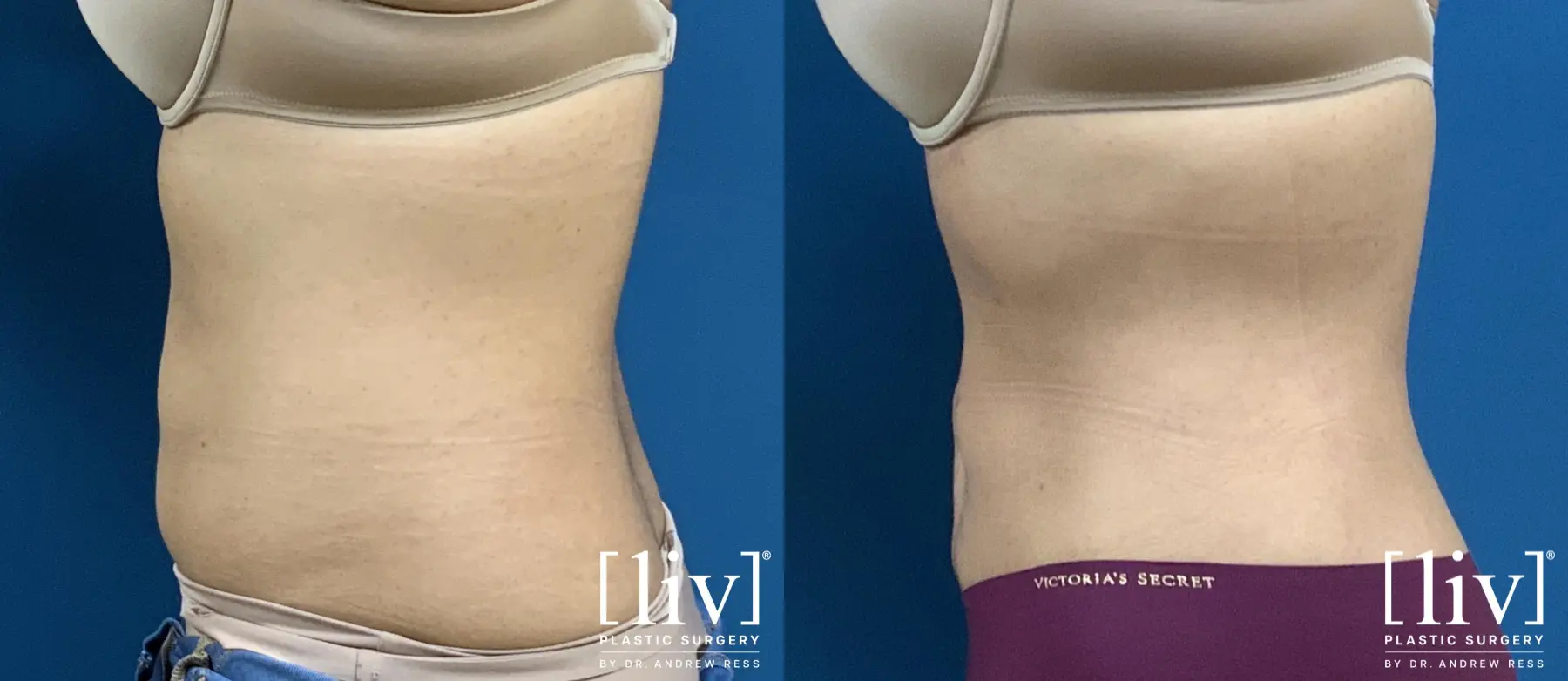 Liposuction - Before and After 3