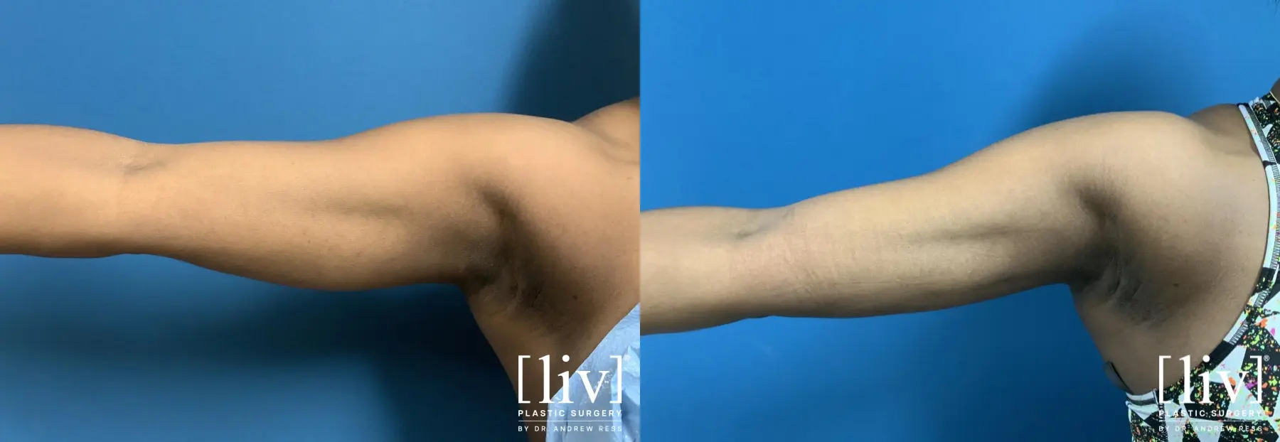 Arm Liposuction - Before and After 1