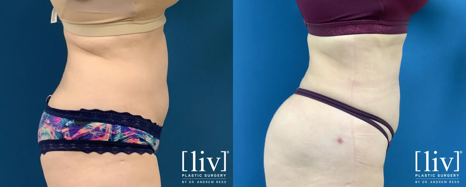 Liposuction: Patient 39 - Before and After 6