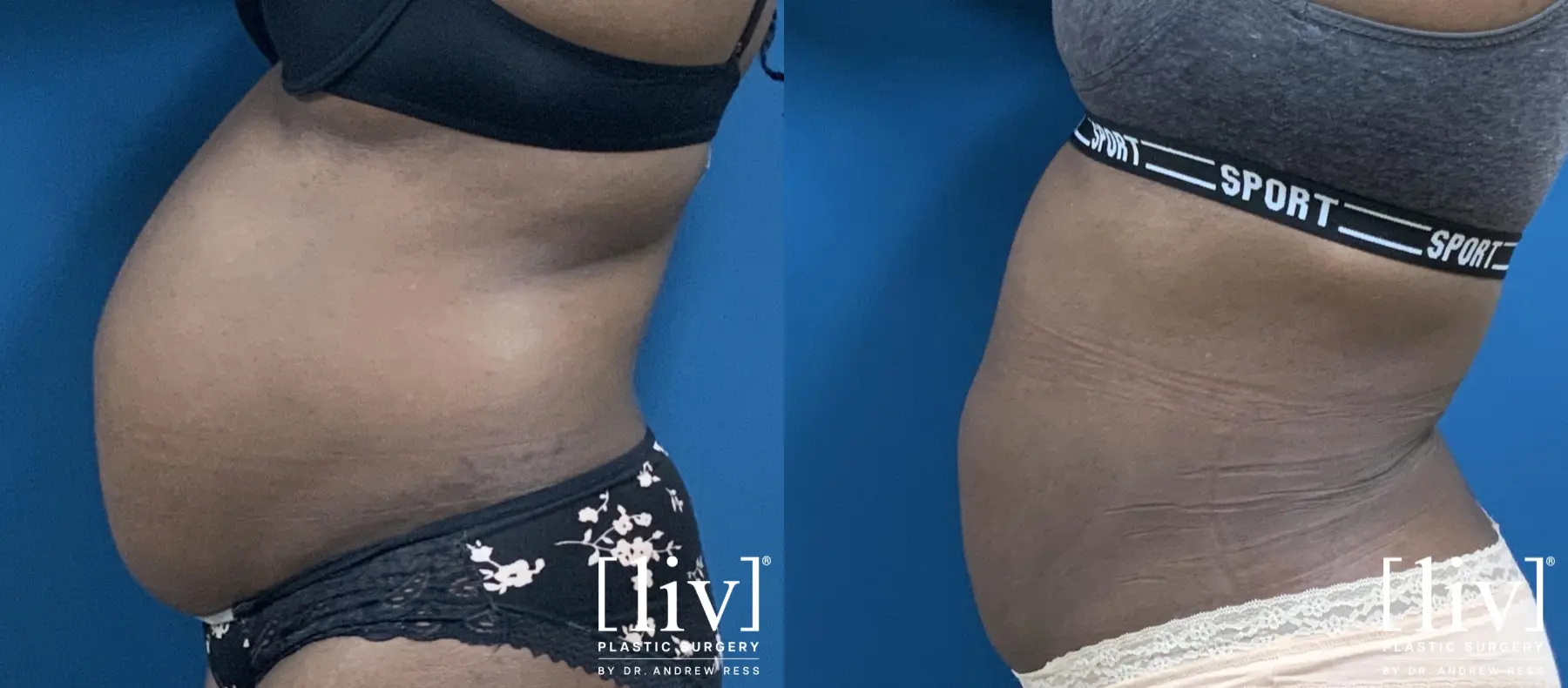 Liposuction - Before and After  