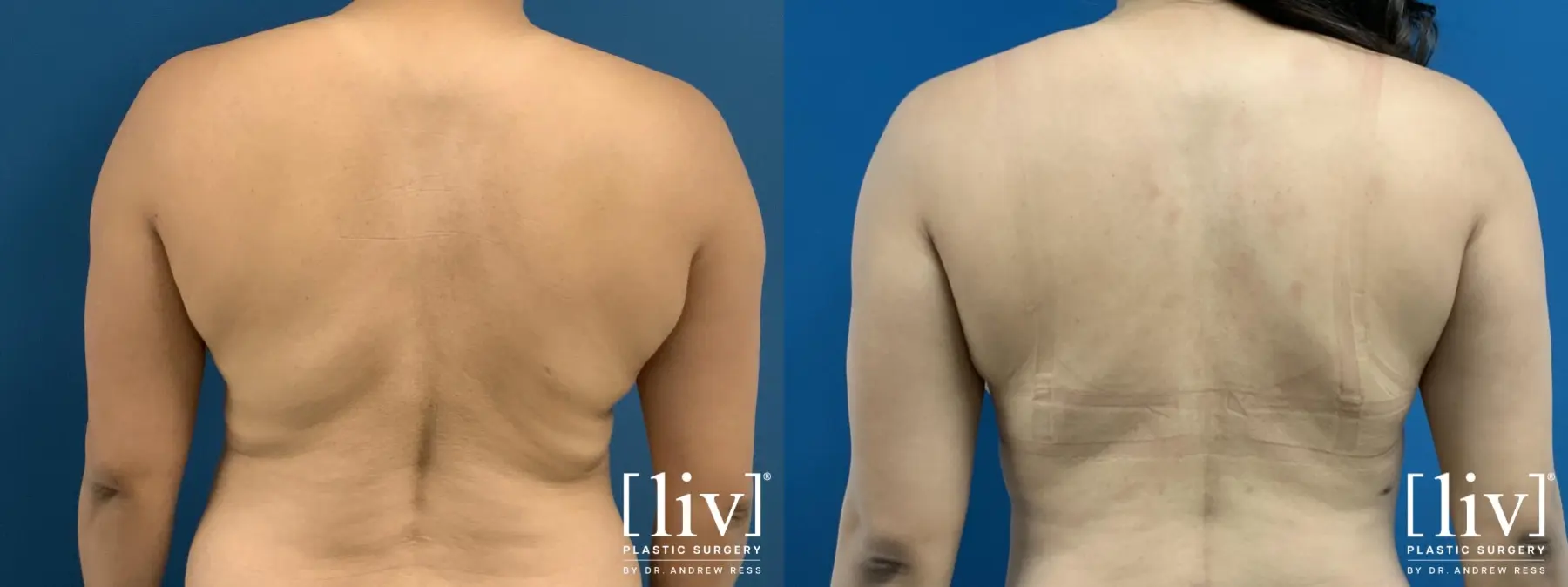 Liposuction: Patient 43 - Before and After 6
