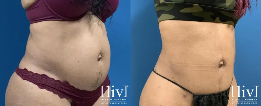 Liposuction: Patient 7 - Before and After 5