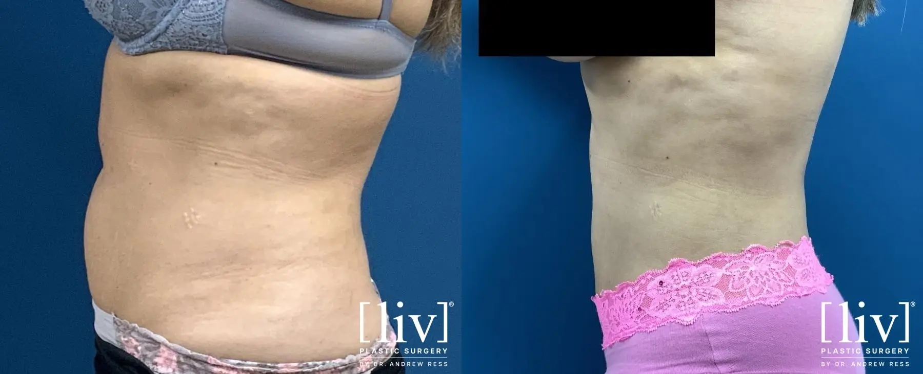 Liposuction: Patient 2 - Before and After 3