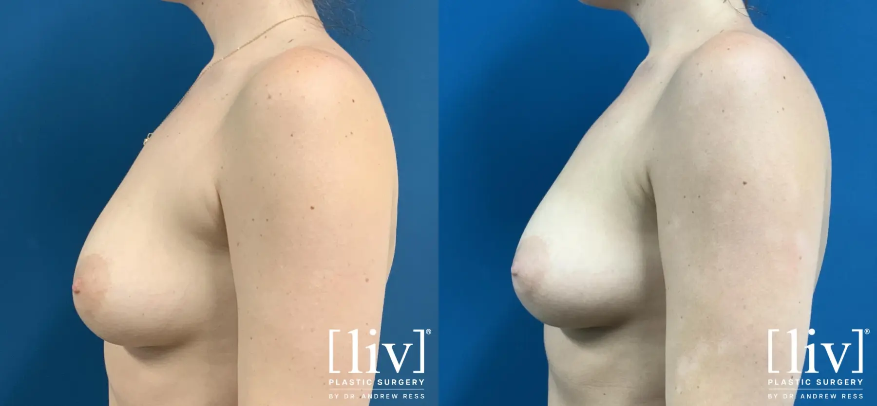 Bra-Fat Liposuction - Before and After 2