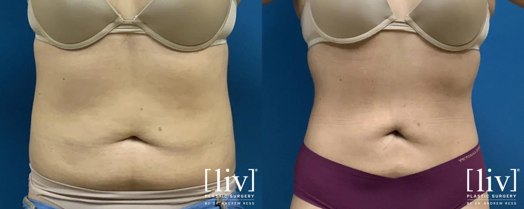 Liposuction - Before and After 1