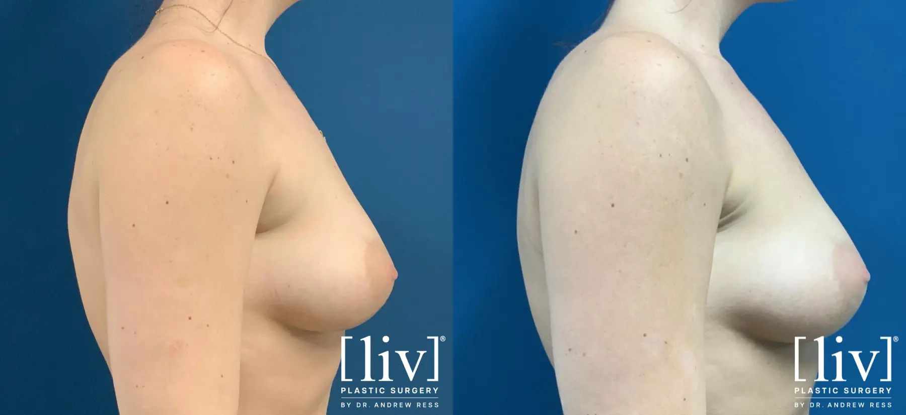 Bra-Fat Liposuction - Before and After 3