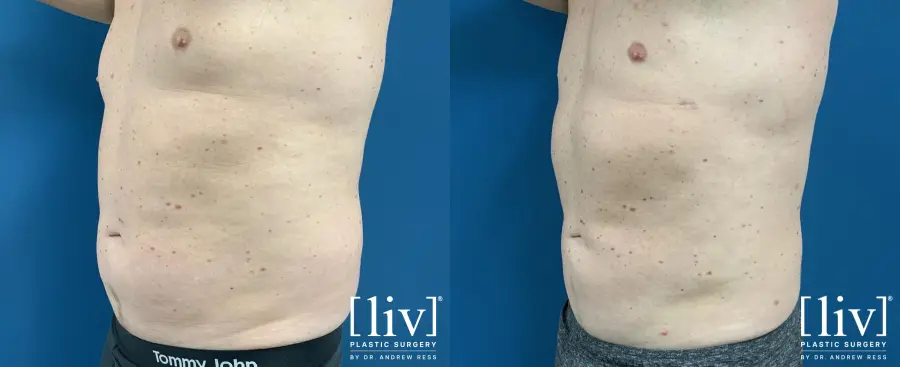 Men Vaser Liposuction - Before and After 2