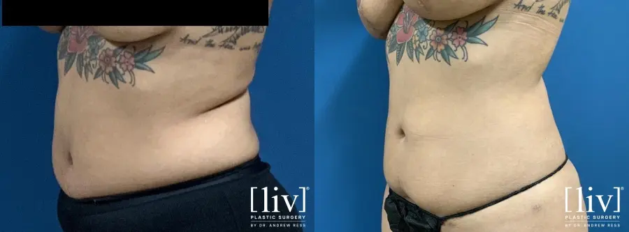 Liposuction: Patient 6 - Before and After 2