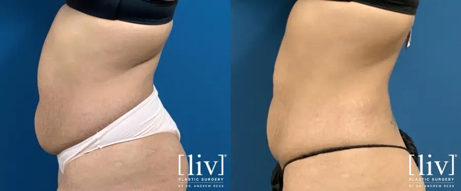 Liposuction: Patient 9 - Before and After 3