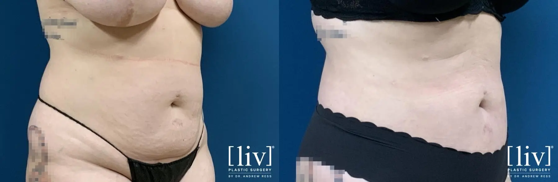 Liposuction: Patient 15 - Before and After 2