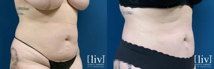 Liposuction: Patient 9 - Before and After 2