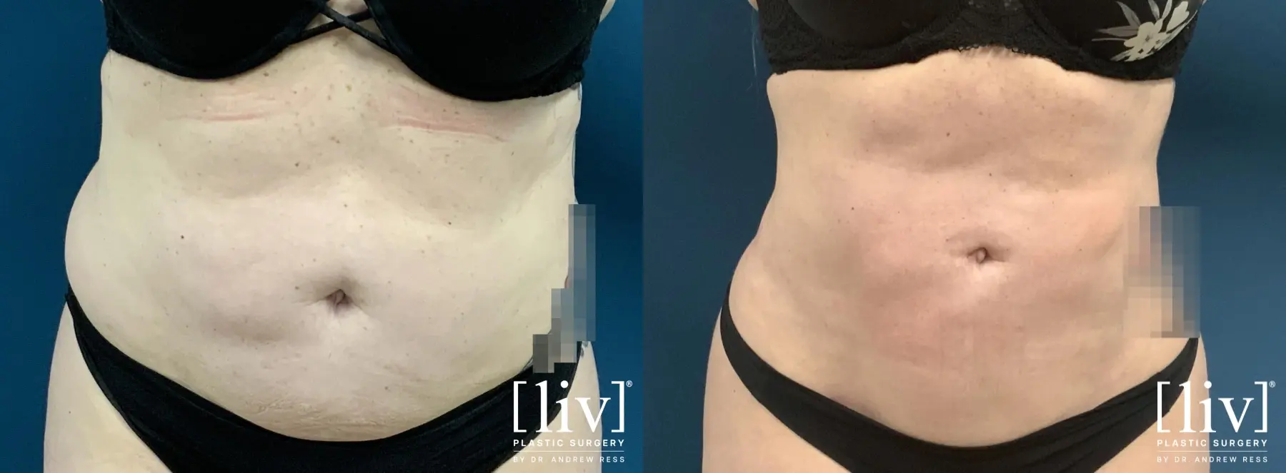 Liposuction: Patient 47 - Before and After 4