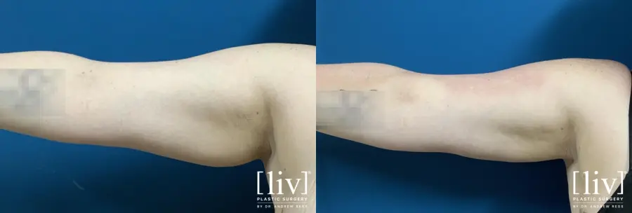 Liposuction: Patient 10 - Before and After  