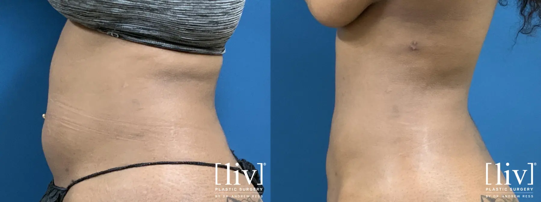 Liposuction: Patient 1 - Before and After 3