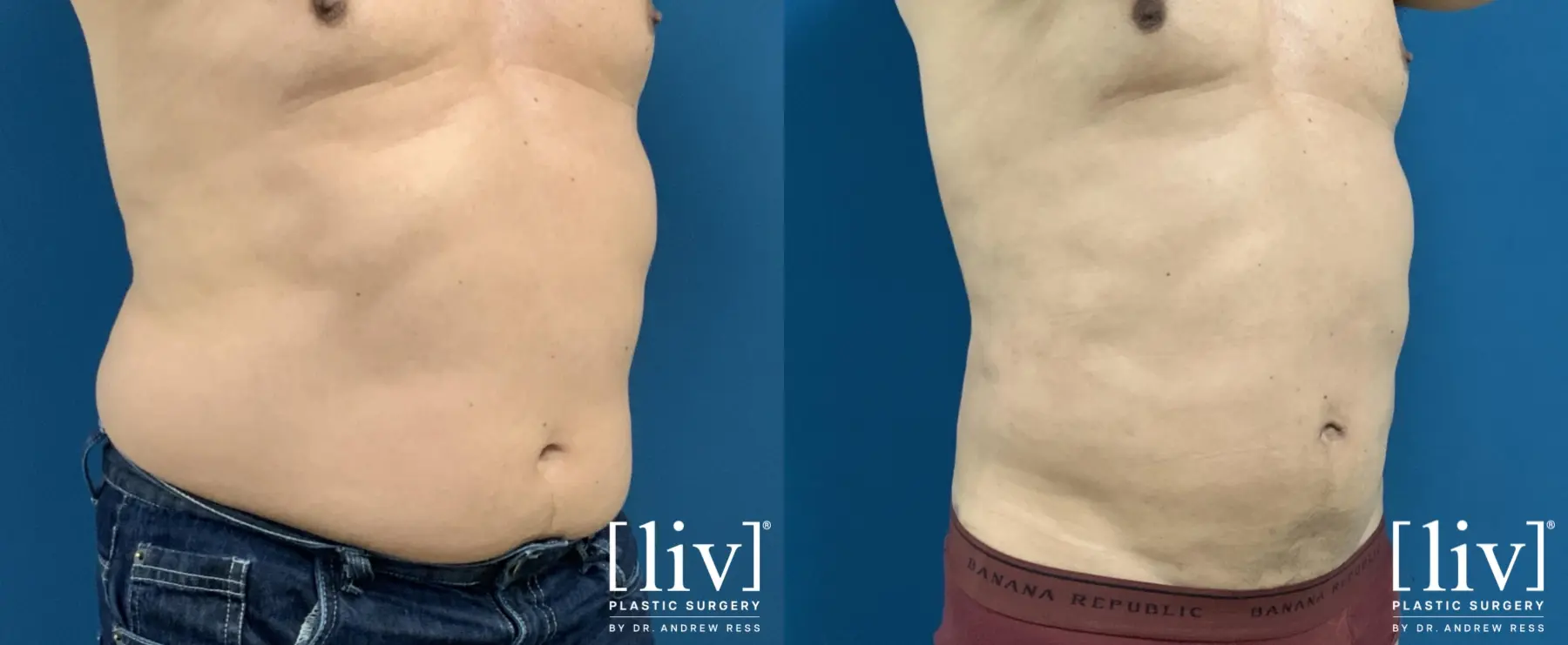 Men Liposuction - Before and After 2