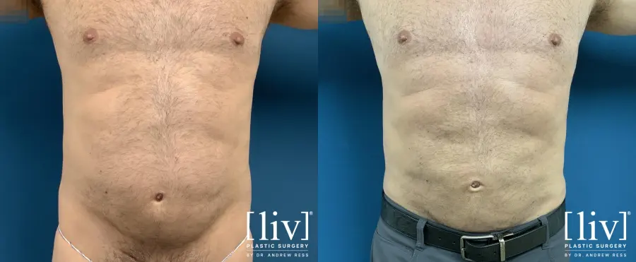 Men Liposuction - Before and After 1