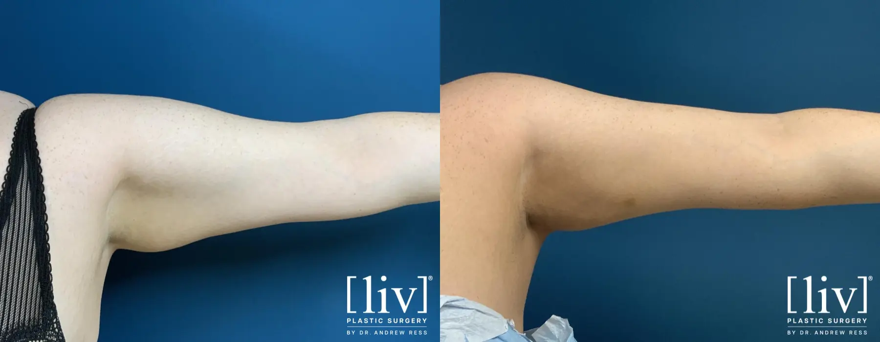 Arm Liposuction - Before and After  