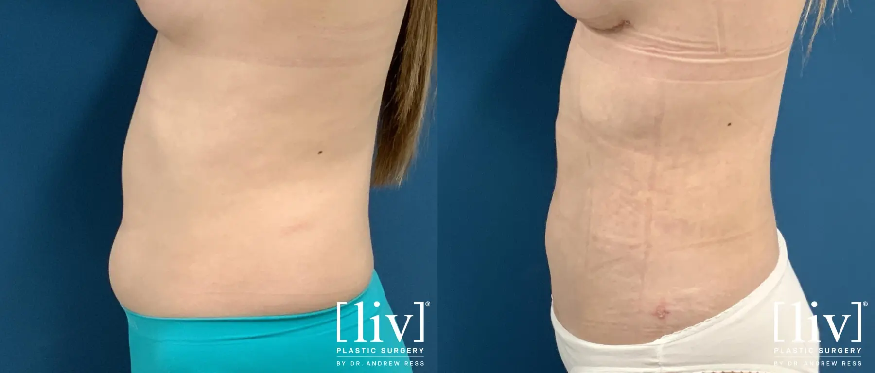Liposuction: Patient 32 - Before and After 3