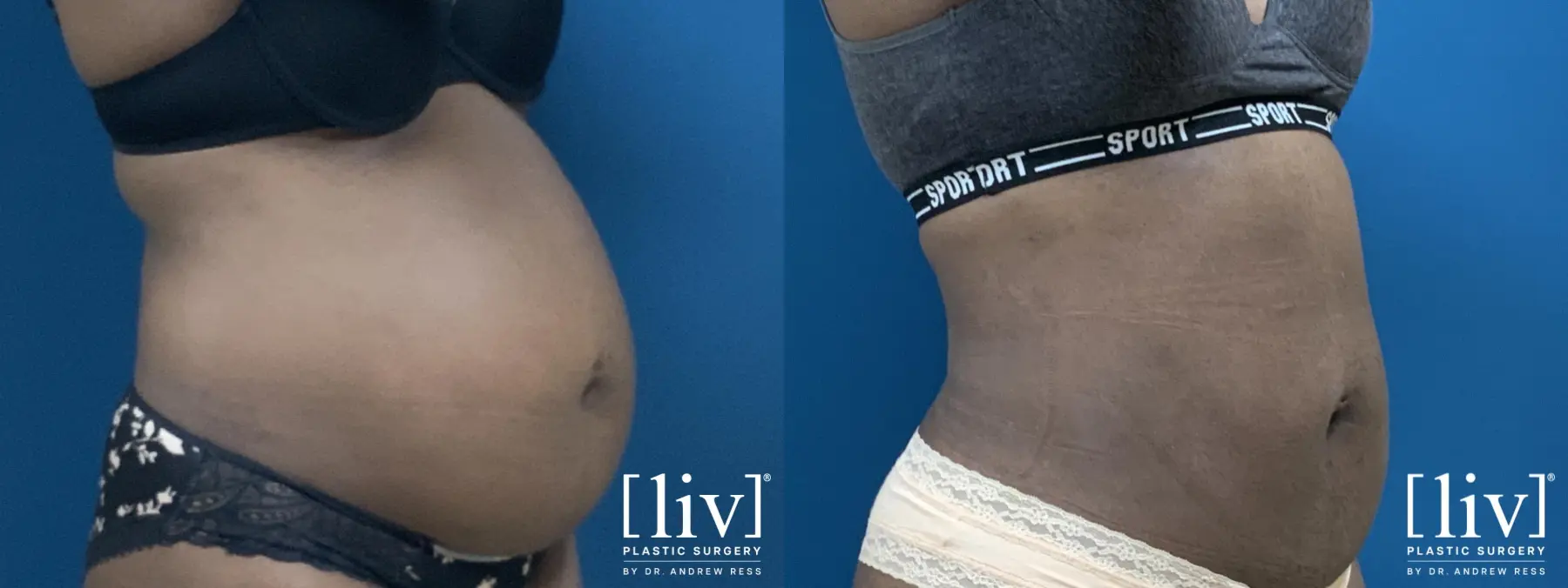 Liposuction - Before and After 4