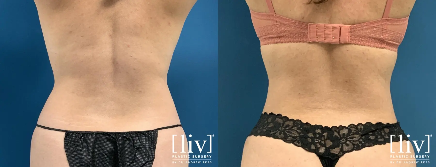 Liposuction: Patient 44 - Before and After 6