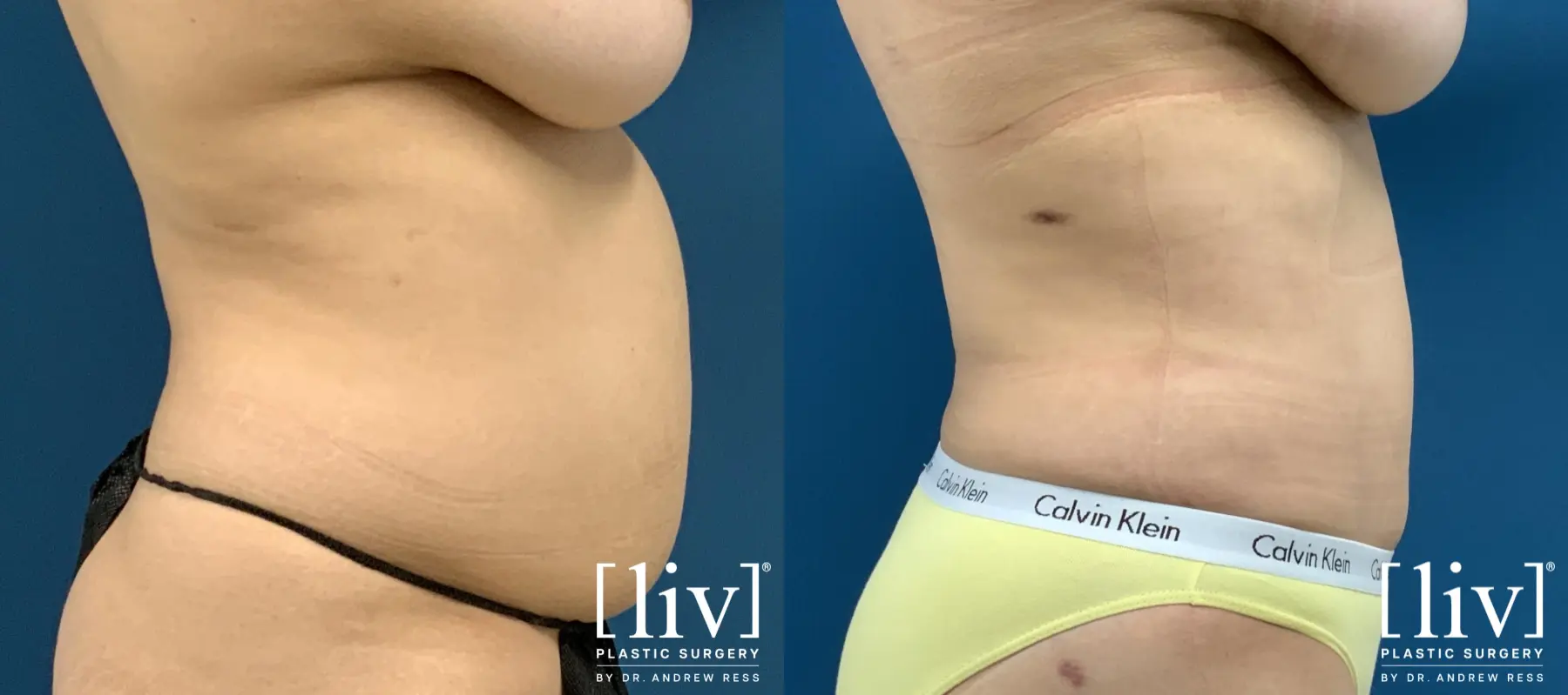 Liposuction: Patient 41 - Before and After 5