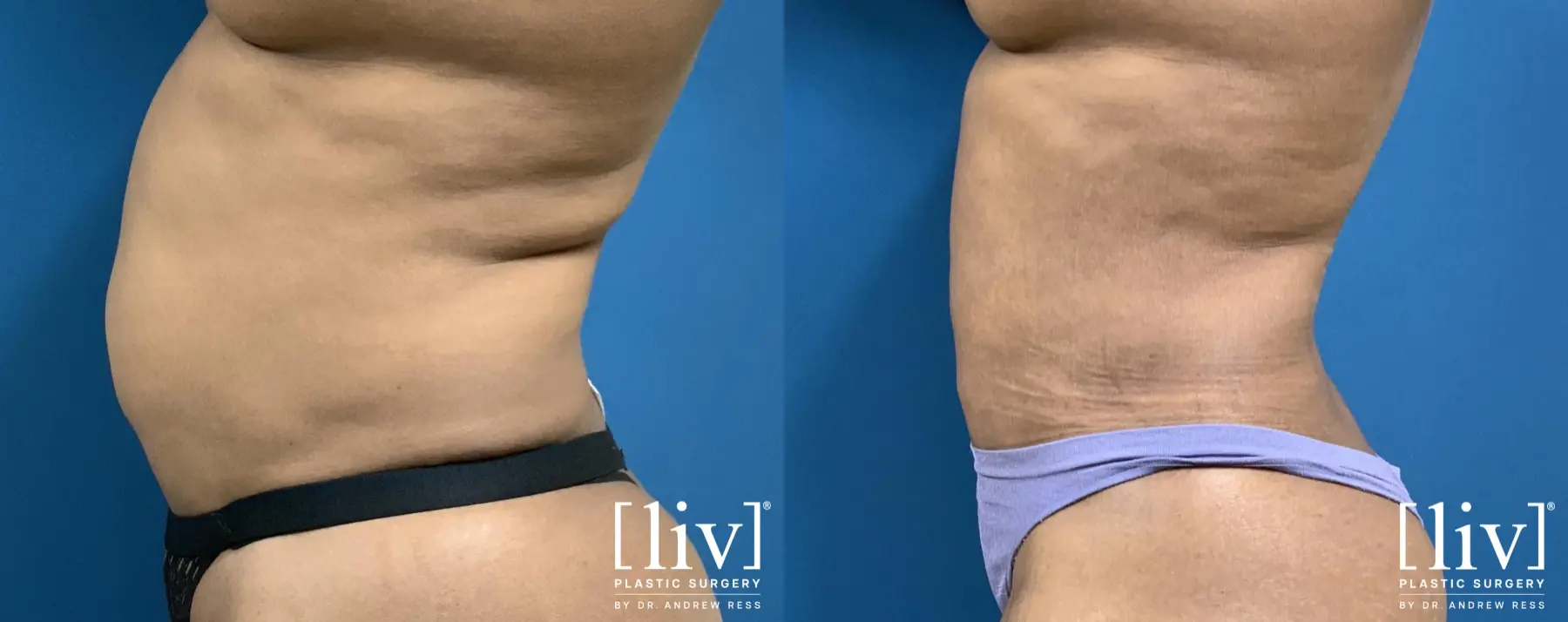 Liposuction: Patient 26 - Before and After 3