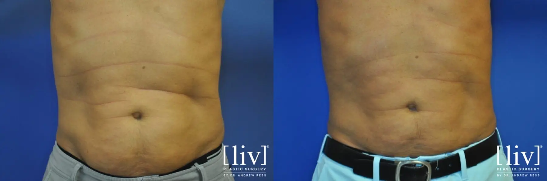 Men Liposuction - Before and After 1