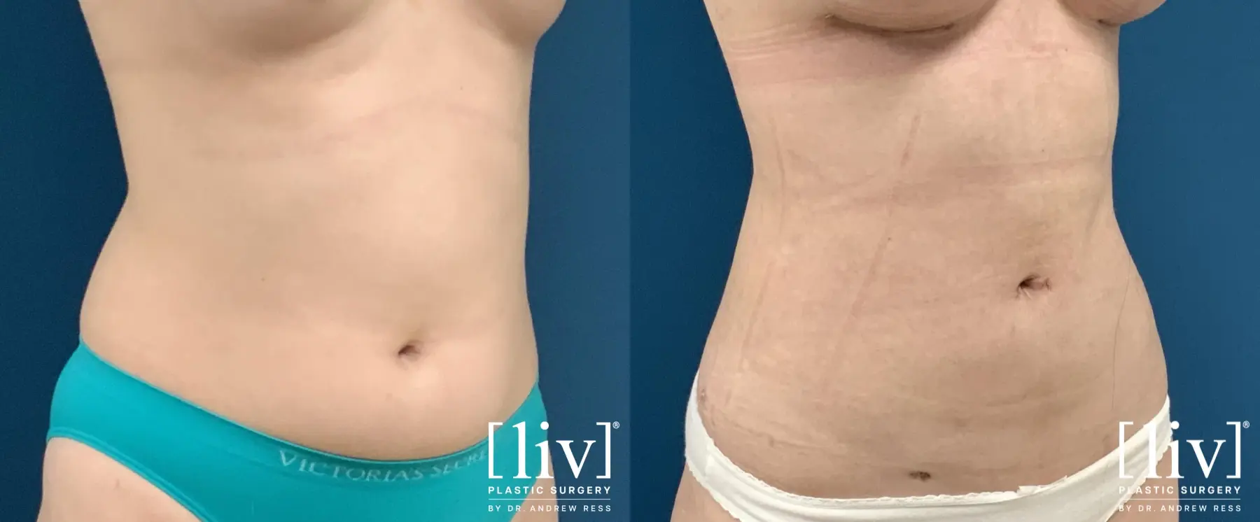 Liposuction: Patient 32 - Before and After 5