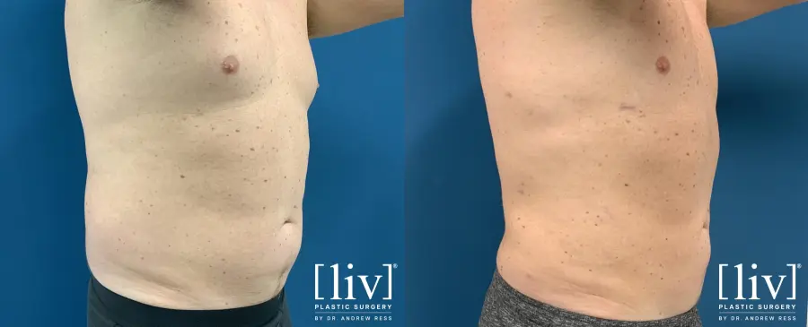 Men Vaser Liposuction - Before and After 4