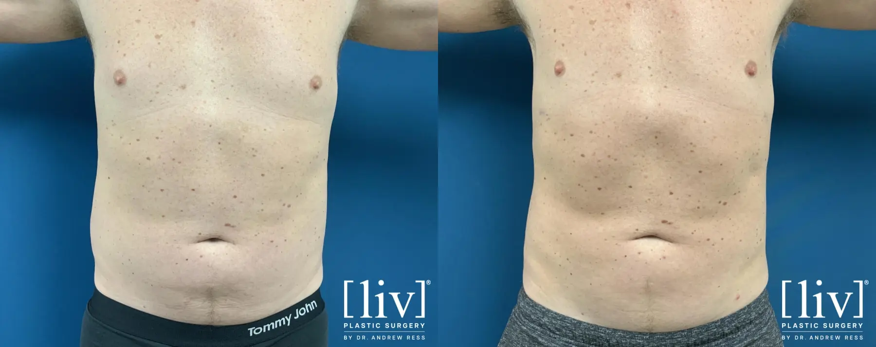Men Liposuction - Before and After 1