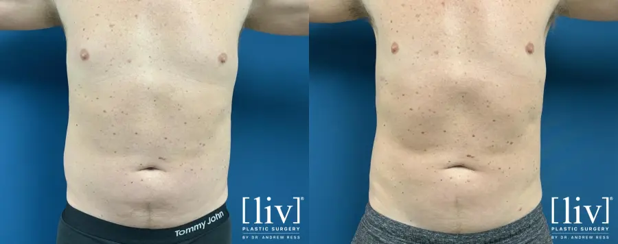 Men Vaser Liposuction - Before and After 1