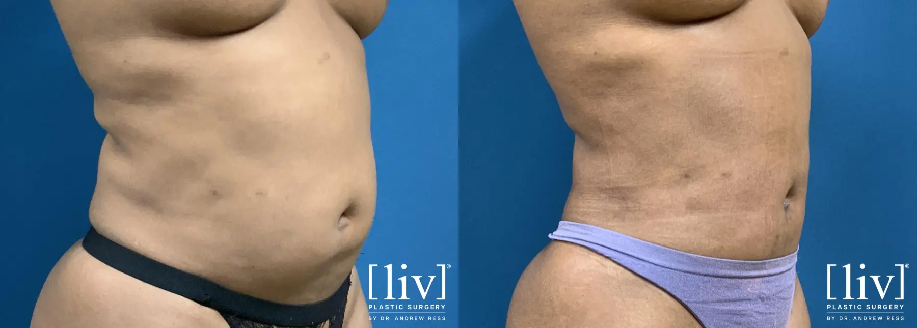 Liposuction: Patient 26 - Before and After 4