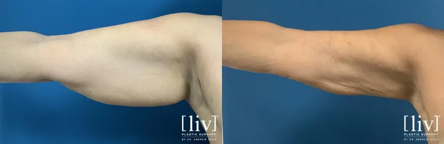 Arm Liposuction - Before and After 1
