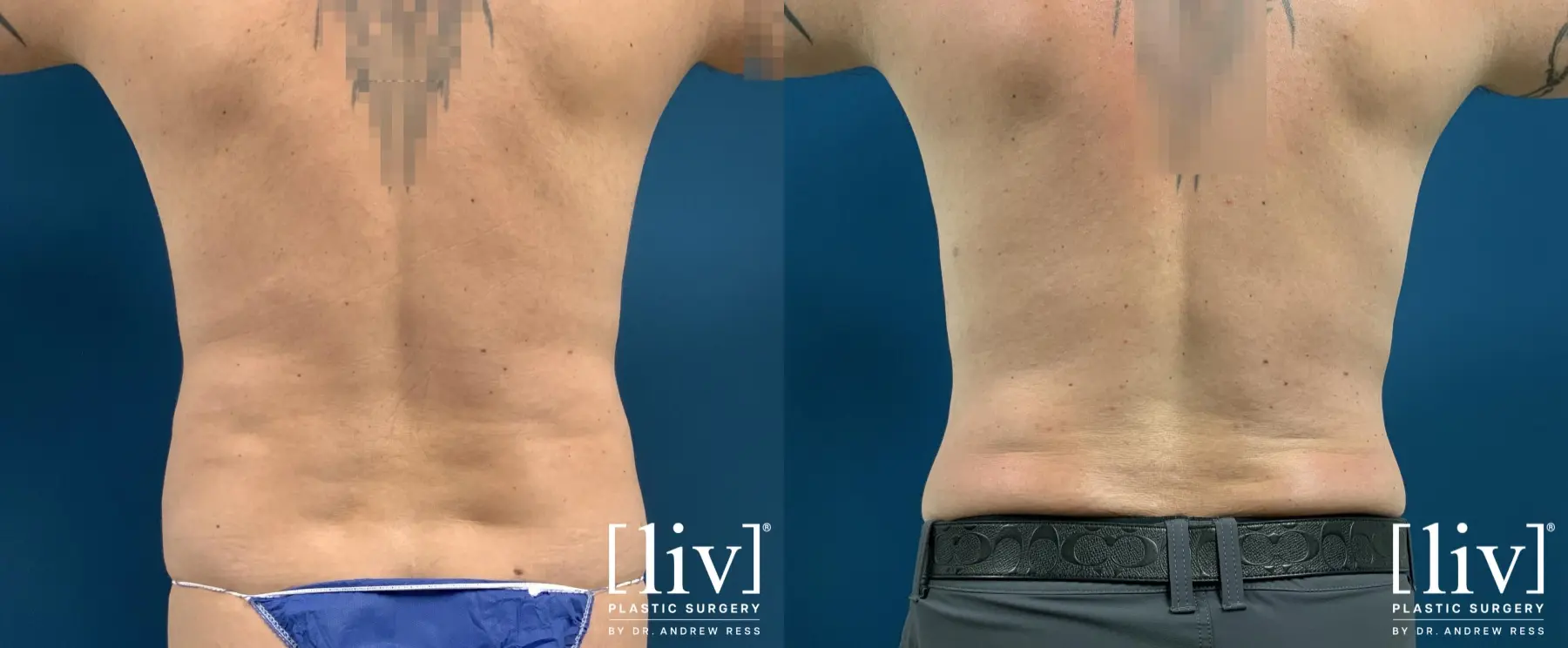 Men Liposuction - Before and After 4